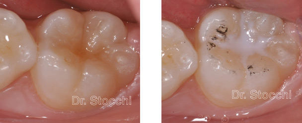 Studio dentistico dr. Marco Stocchi, dente da sigillare e dopo l'esecuzione della sigillatura
