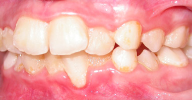 Studio dentistico dr. Marco Stocchi, denti ricoperti di placca batterica