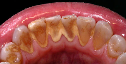 Studio dentistico dr. Marco Stocchi, denti ricoperti di tartaro
